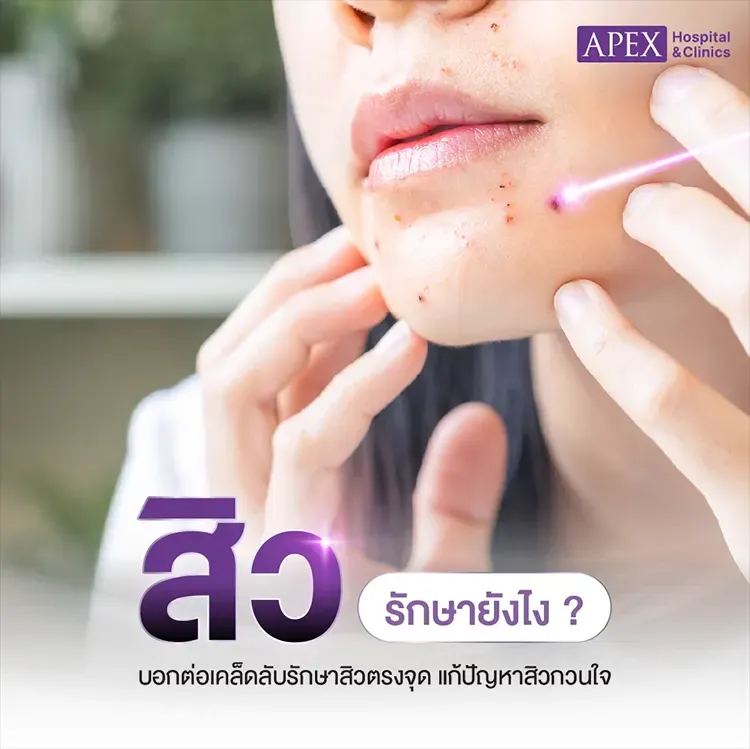 สิว (Acne)
