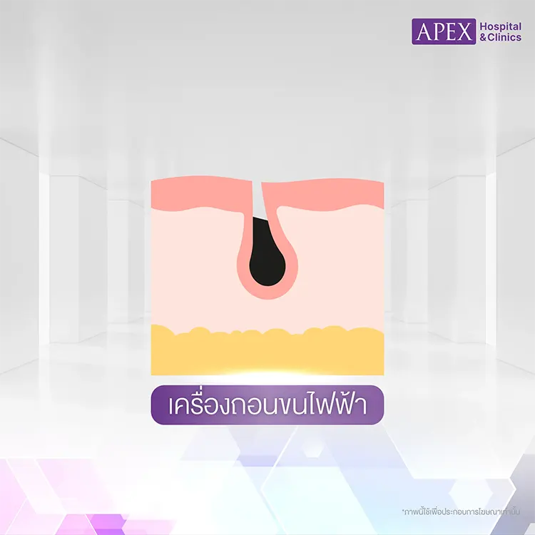 เครื่องถอนขนแบบไฟฟ้า