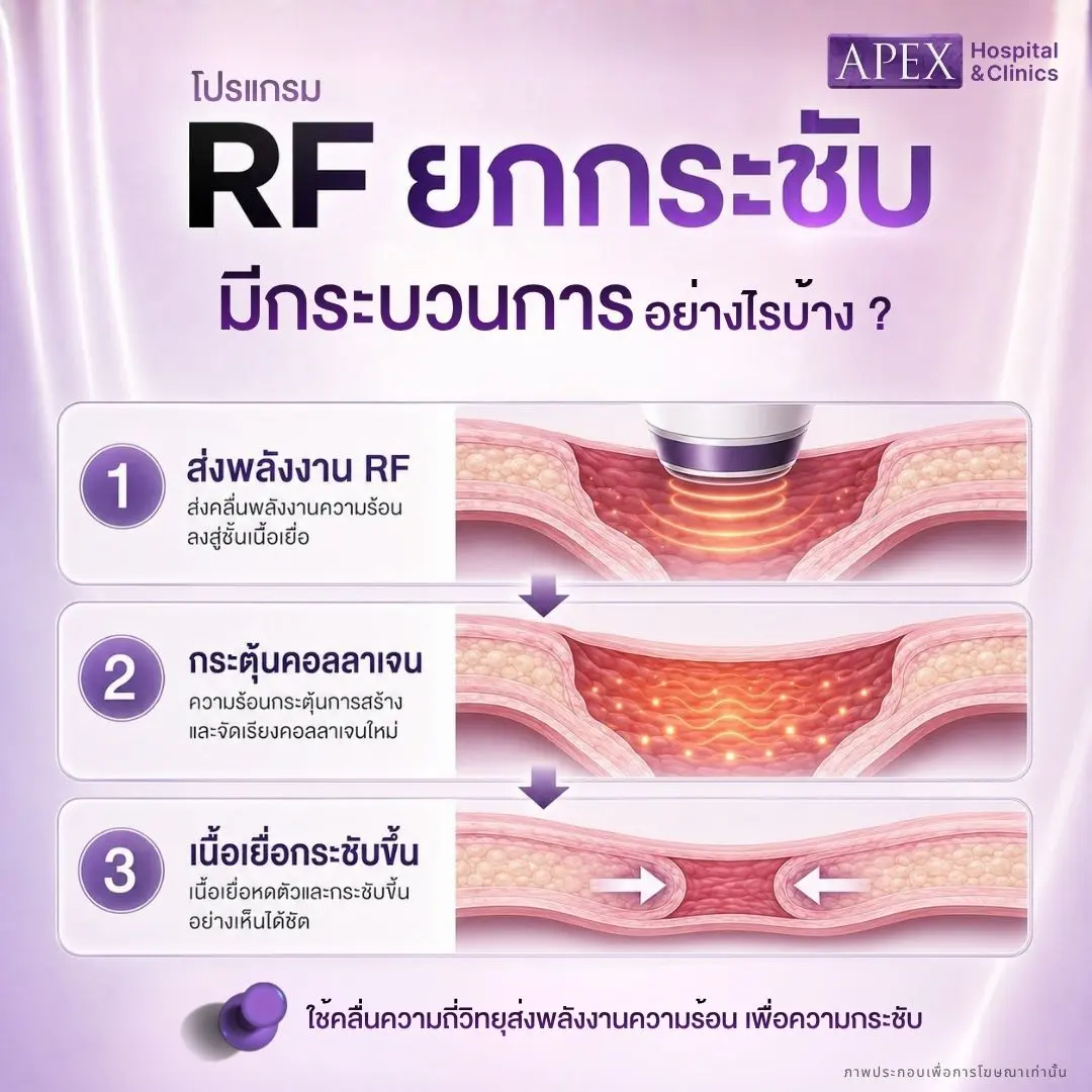 เครื่องยกกระชับ (RF)