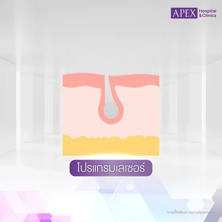 เลเซอร์ขนถอนขน