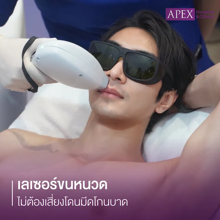 เลเซอร์หนวด