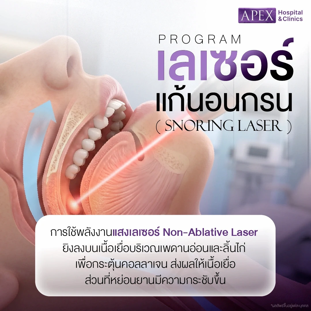 เลเซอร์แก้นอนกรน ทำงานอย่างไร