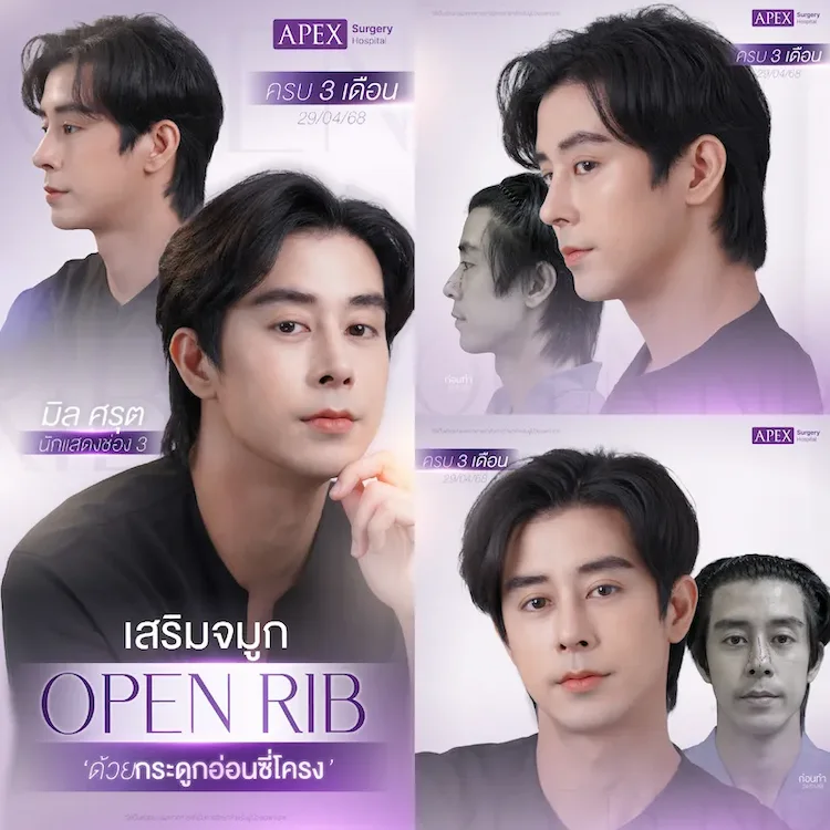 เสริมจมูก
