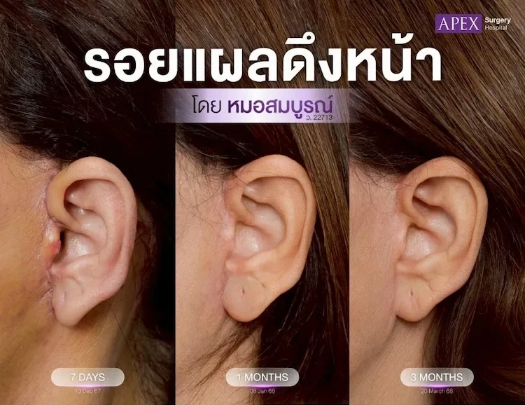 แผลหลังดึงหน้า