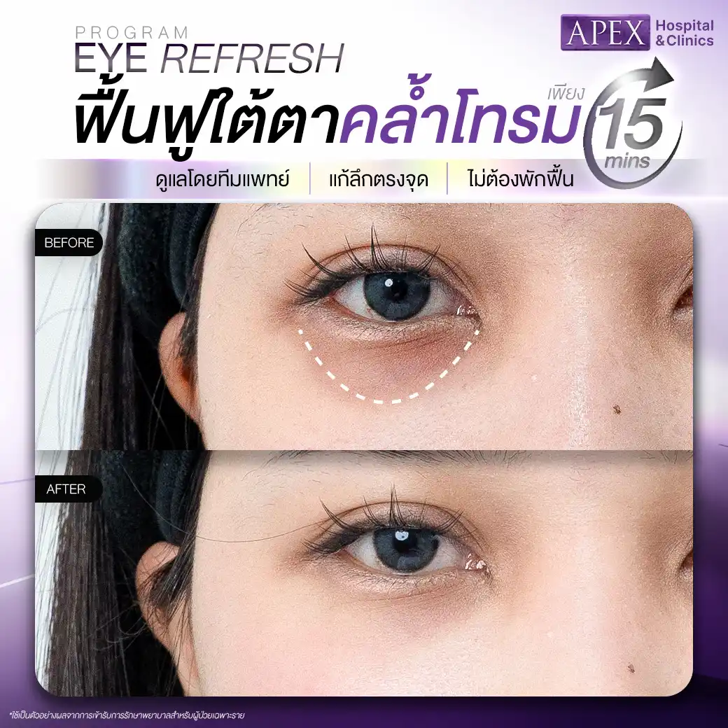 รีวิว Eye Refresh