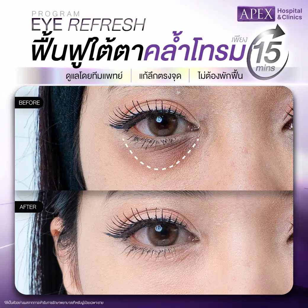 รีวิว Eye Refresh