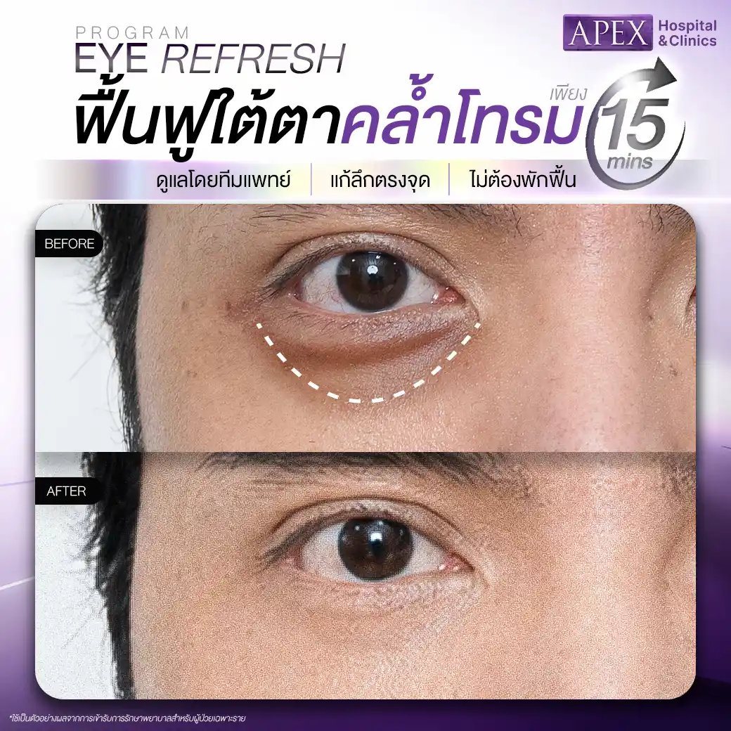 รีวิว Eye Refresh