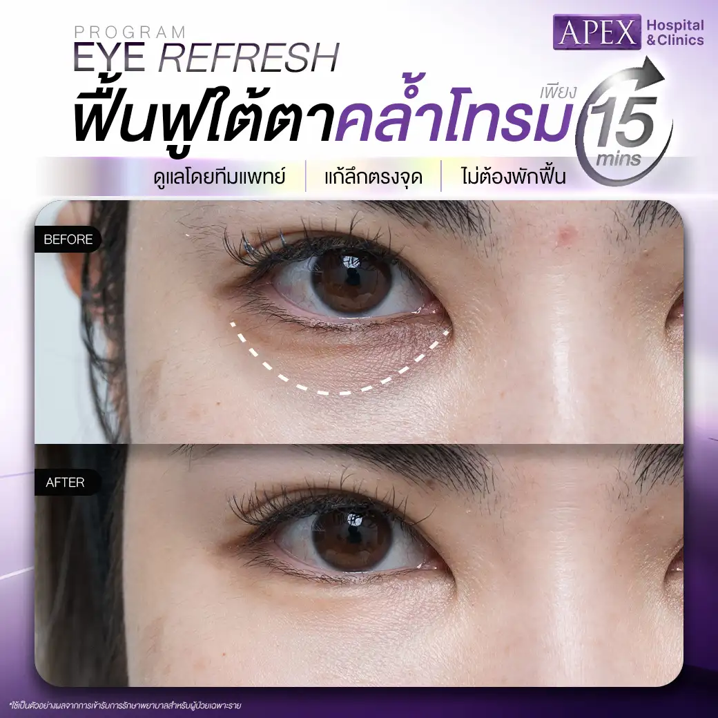รีวิว Eye Refresh