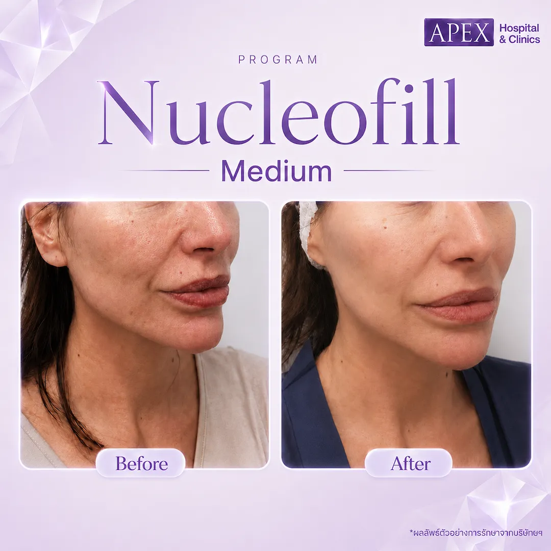 รีวิว Nucleofill Medium