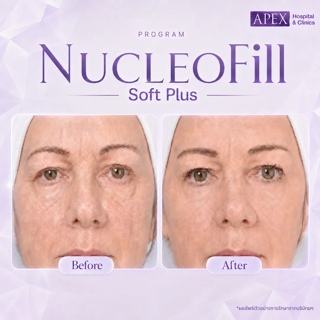รีวิว Nucleofill Soft Plus
