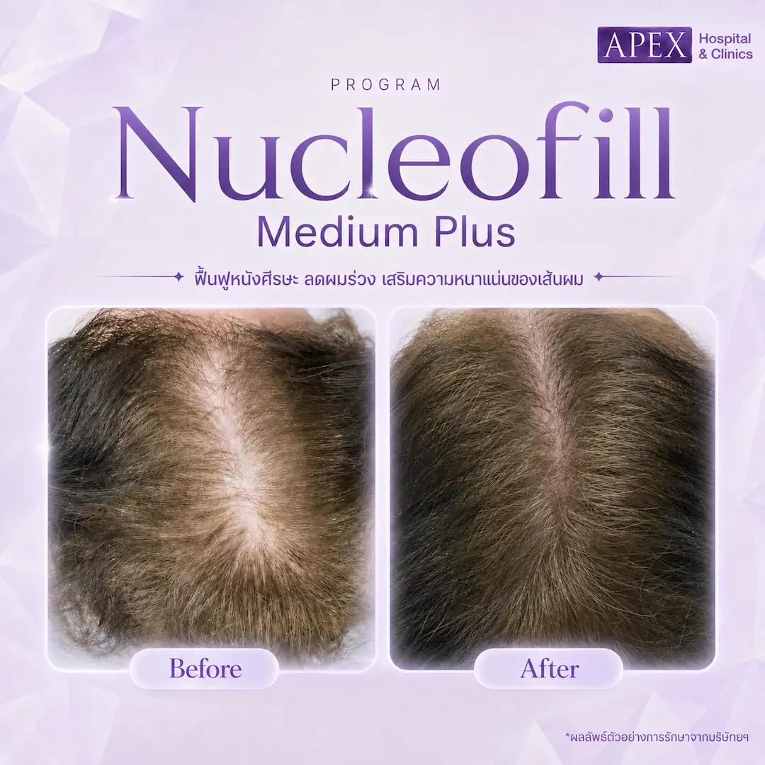 รีวิว Nucleofill Medium Plus