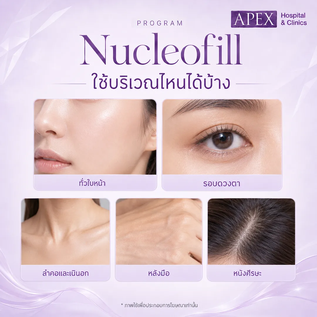 Nucleofill ฉีดบริเวณไหนได้บ้าง