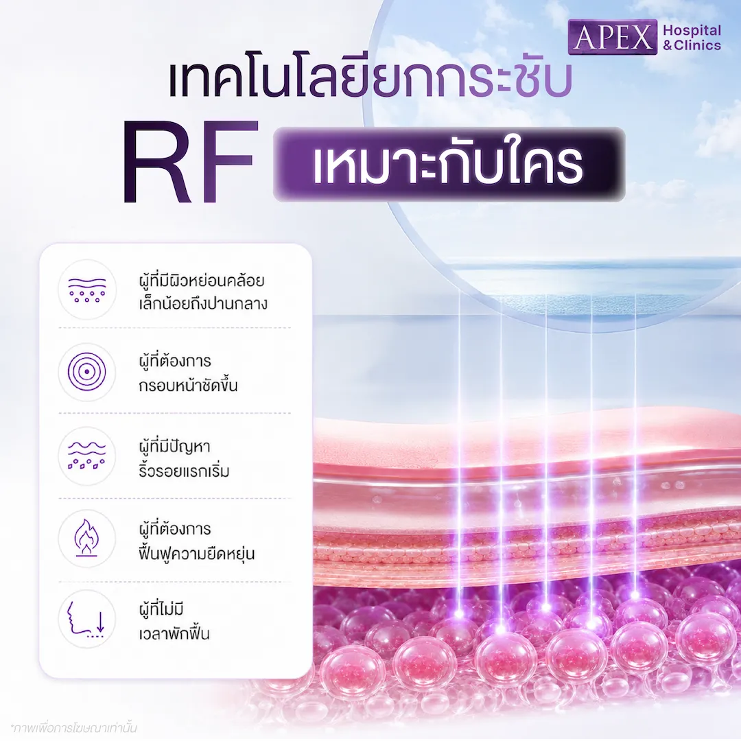 RF (Radio-Frequency) เหมาะกับใคร