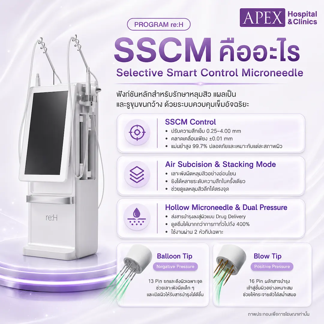 SSCM ในเครื่อง re:H