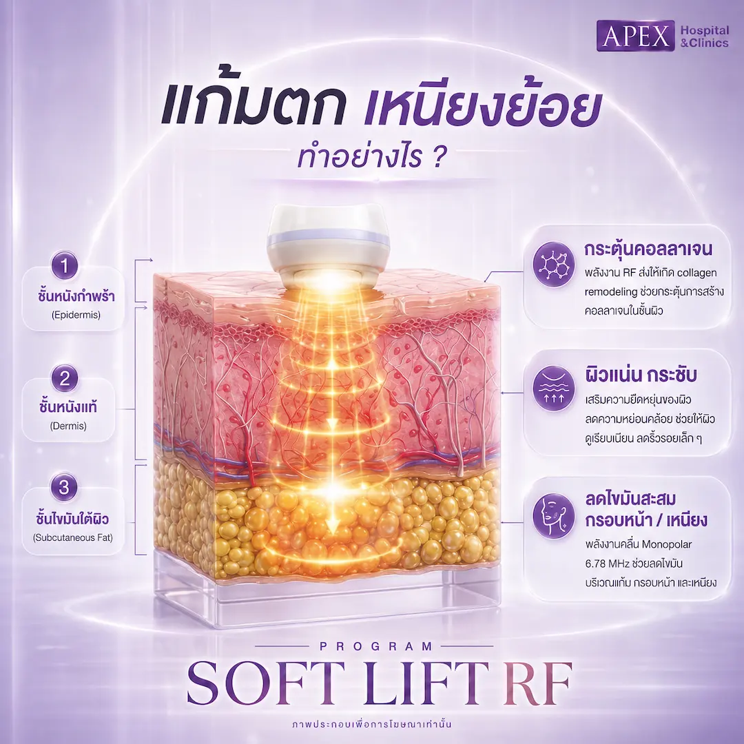 การทำงานของ Soft Lift RF
