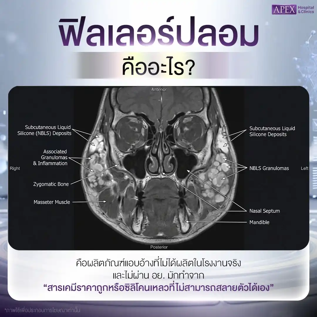 ฟิลเลอร์ปลอม คืออะไร