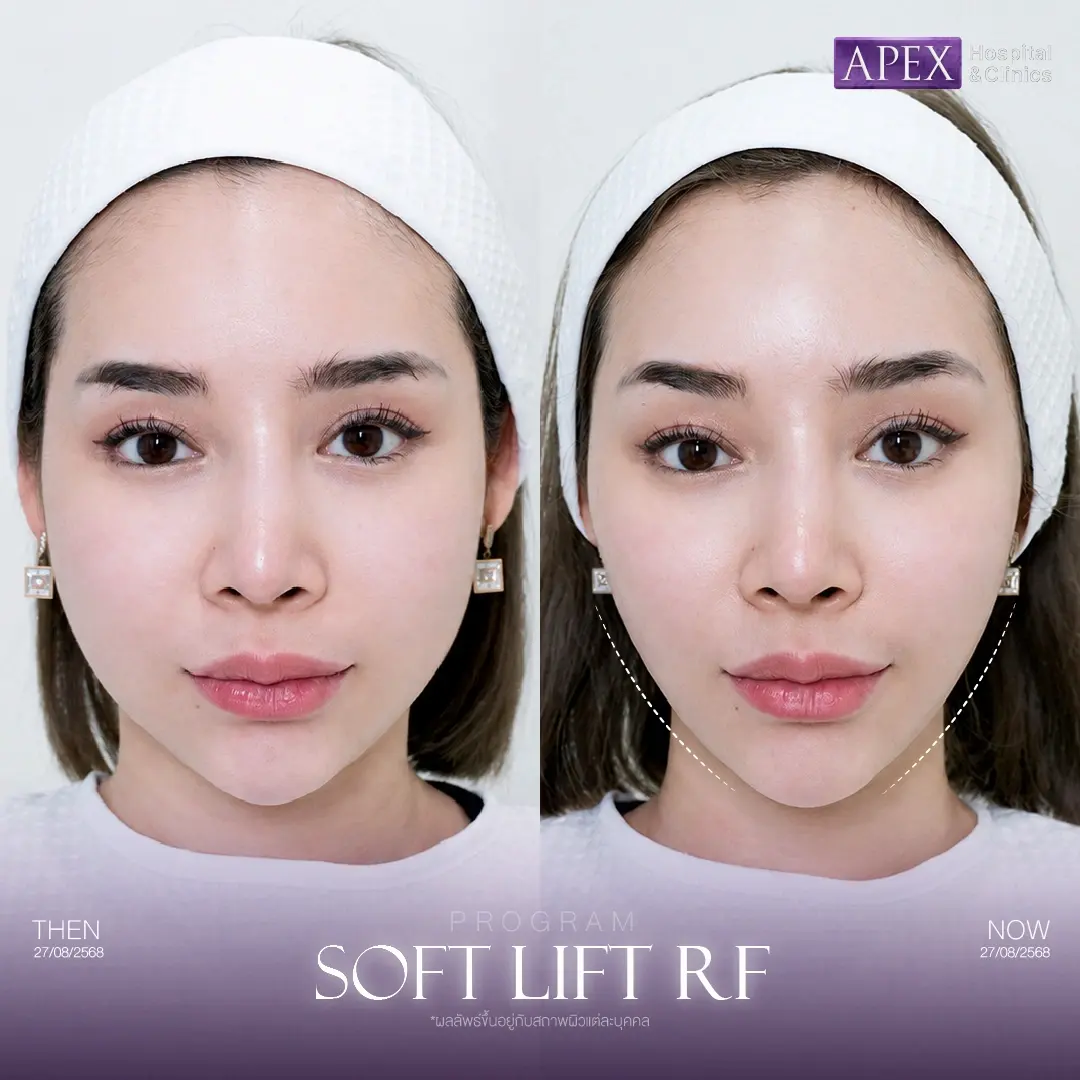 รีวิว Soft Lift RF