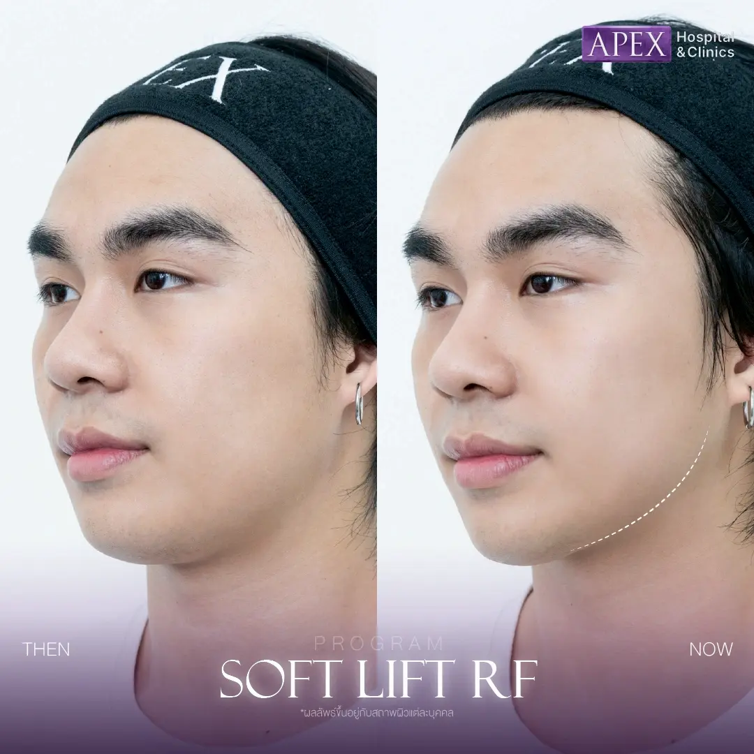 รีวิว Soft Lift RF