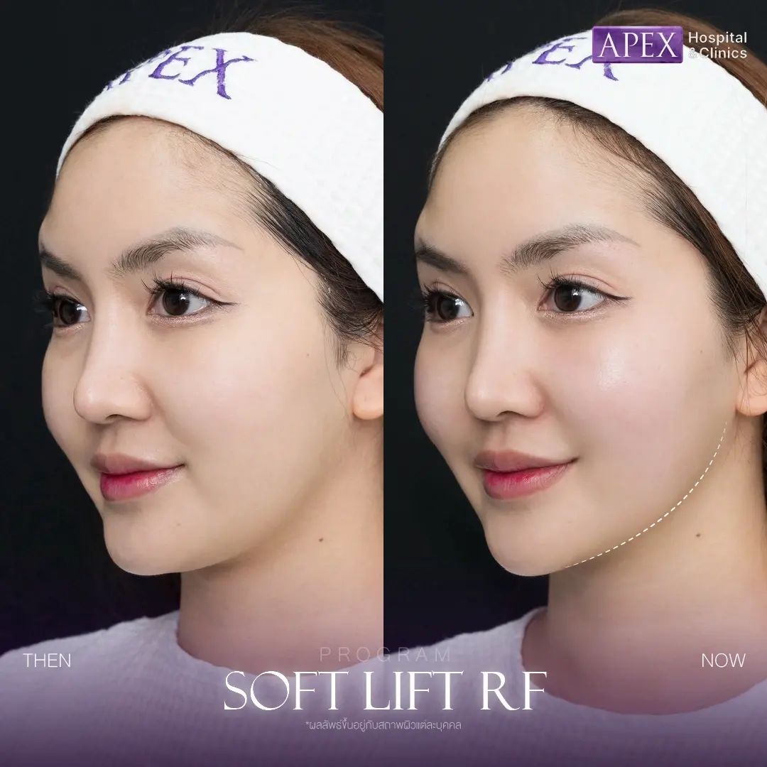 รีวิว Soft Lift RF