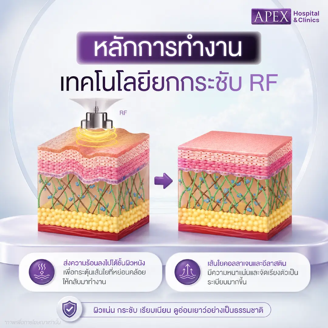 หลักการทำงานของคลื่น RF