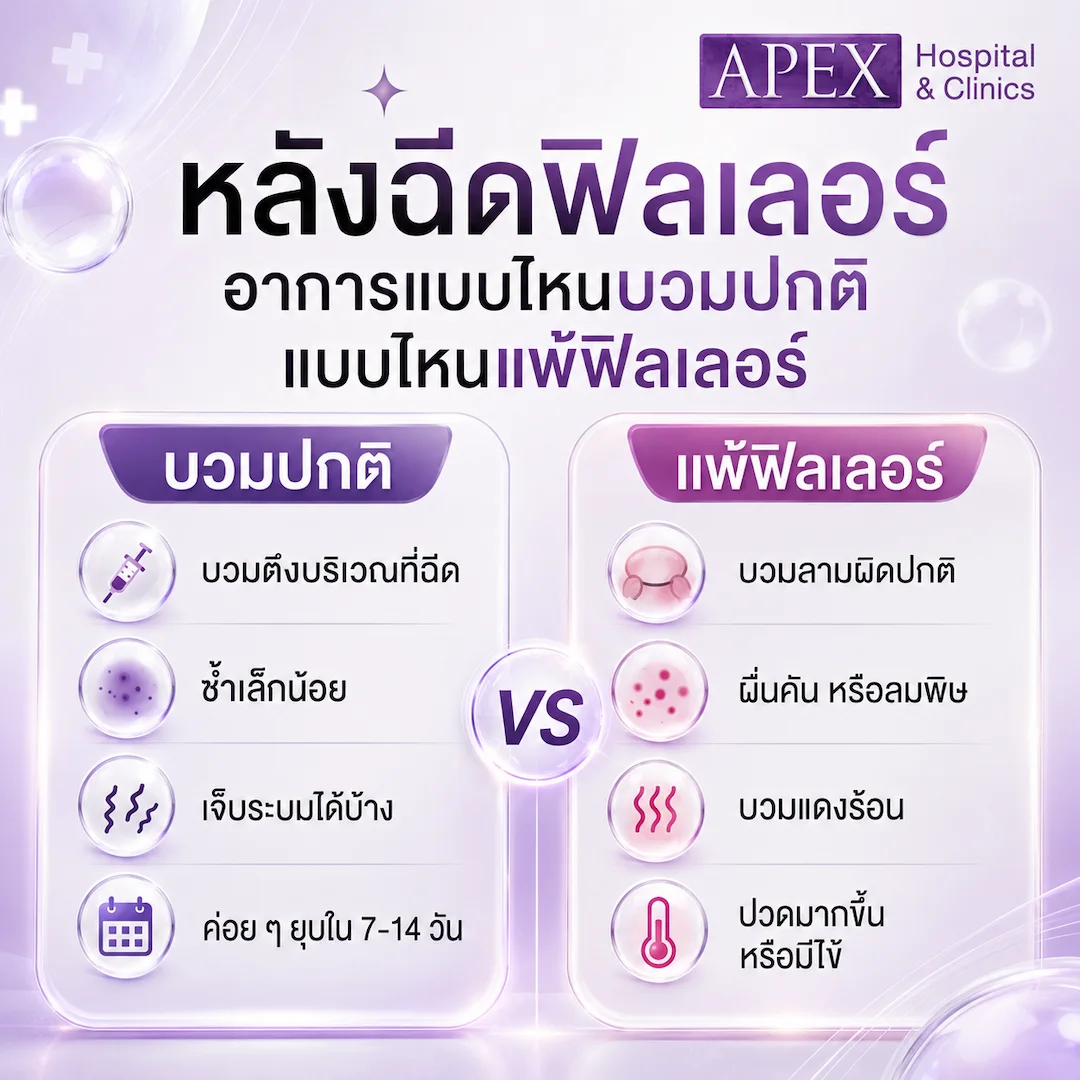 หลังฉีดฟิลเลอร์ อาการแบบไหนบวมปกติ แบบไหนแพ้ฟิลเลอร์