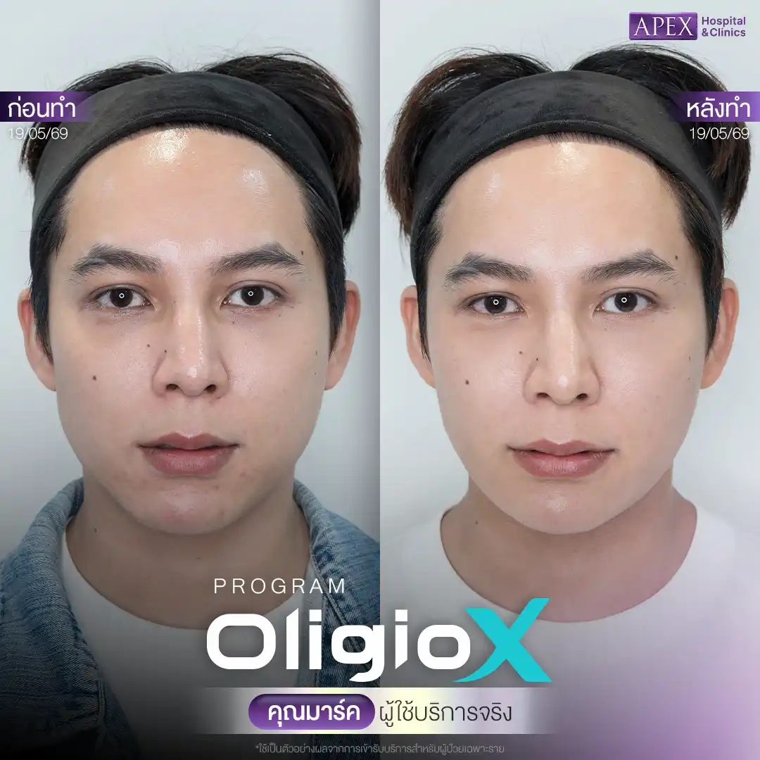 หลังทำ Oligio ควรทำซ้ำเมื่อไหร่