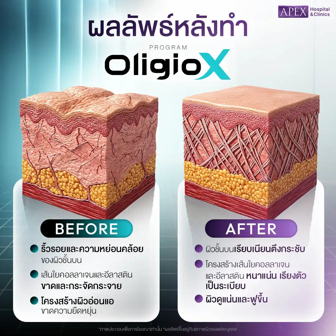 หลังทำ Oligio ผิวเปลี่ยนแปลงอย่างไรในแต่ละช่วง