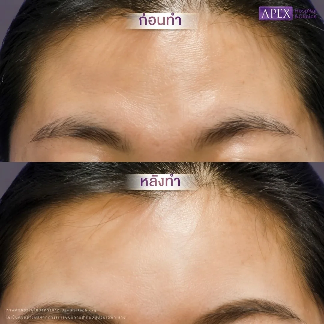 เคส 1 หลังฉีดฟิลเลอร์ Neuramis