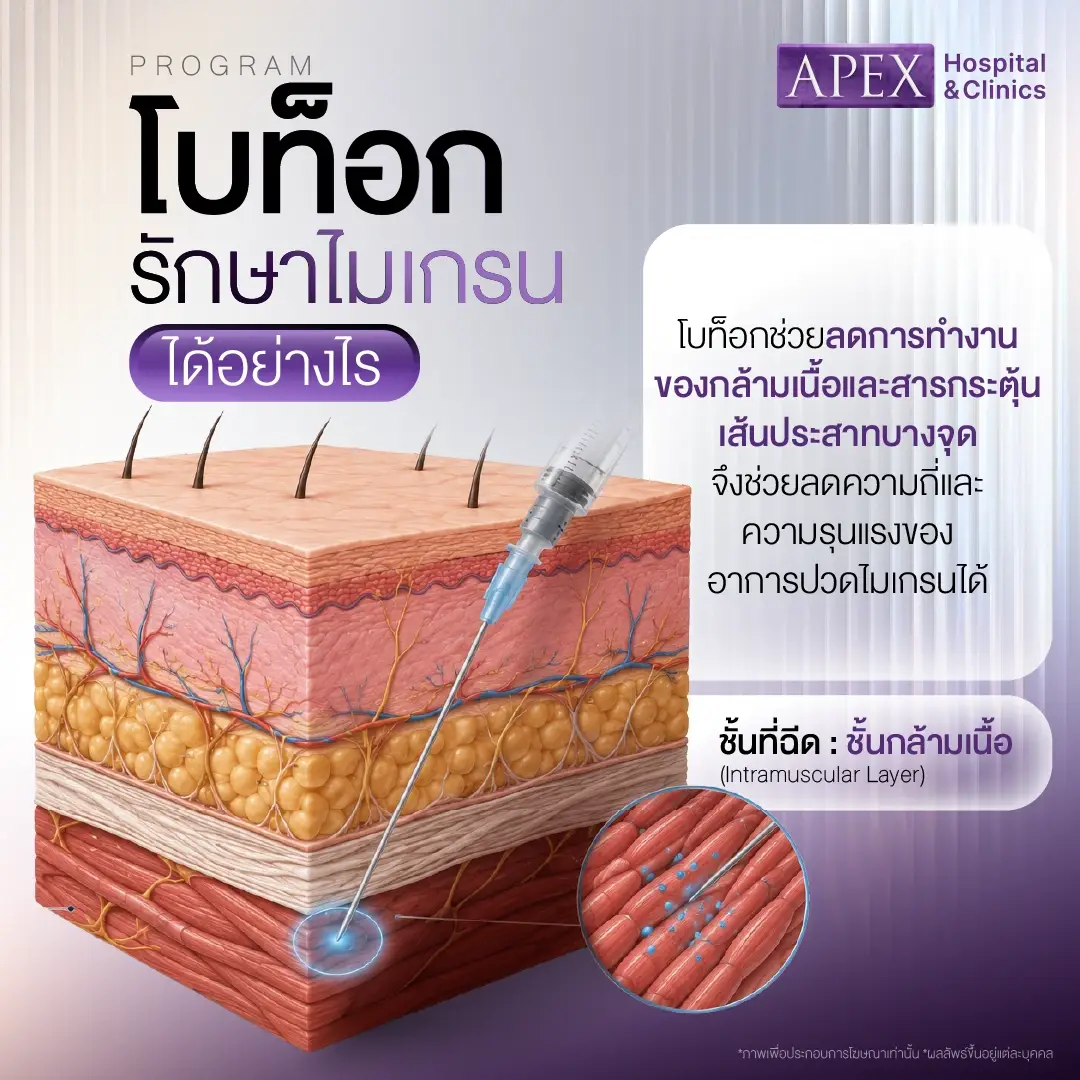 โบท็อกรักษาไมเกรน ได้อย่างไร