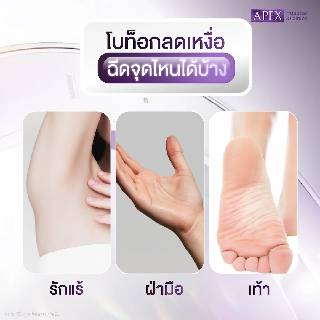 โบท็อกลดเหงื่อ ฉีดบริเวณไหนได้บ้าง