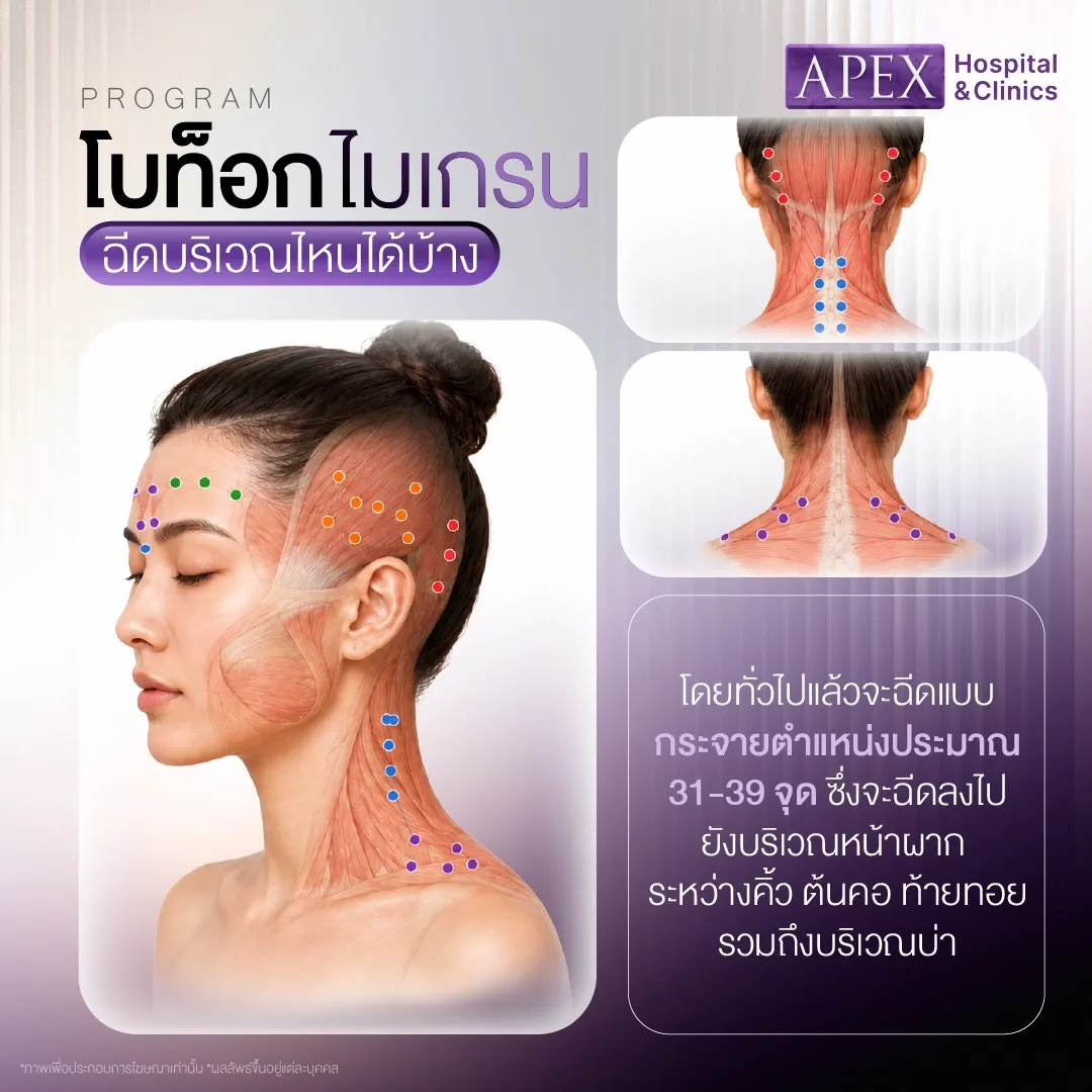 โบท็อกไมเกรน ฉีดบริเวณไหนบ้าง