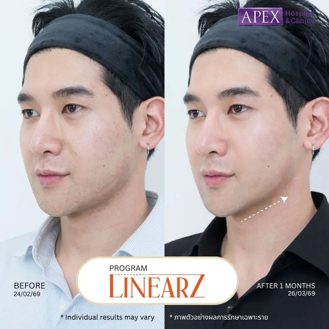 LinearZ ยกกระชับหน้า