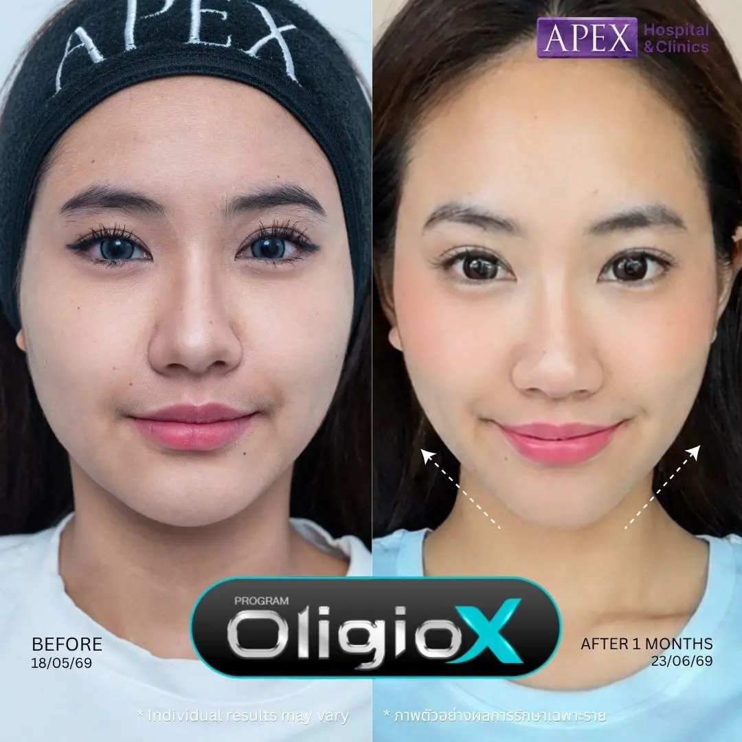 Oligio ยกกระชับหน้า