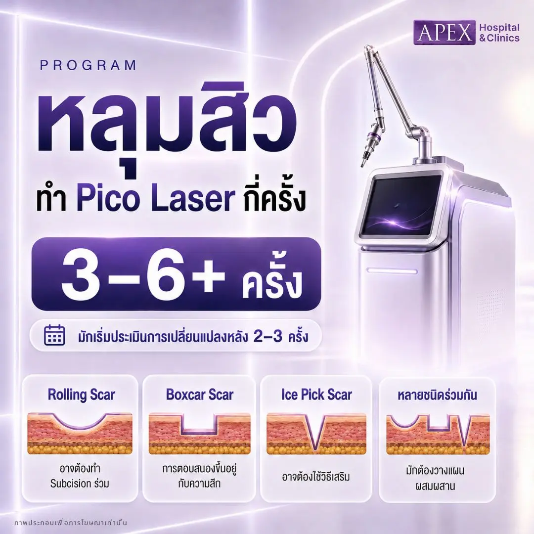 Pico Laser หลุมสิวกี่ครั้งถึงเห็นการเปลี่ยนแปลง