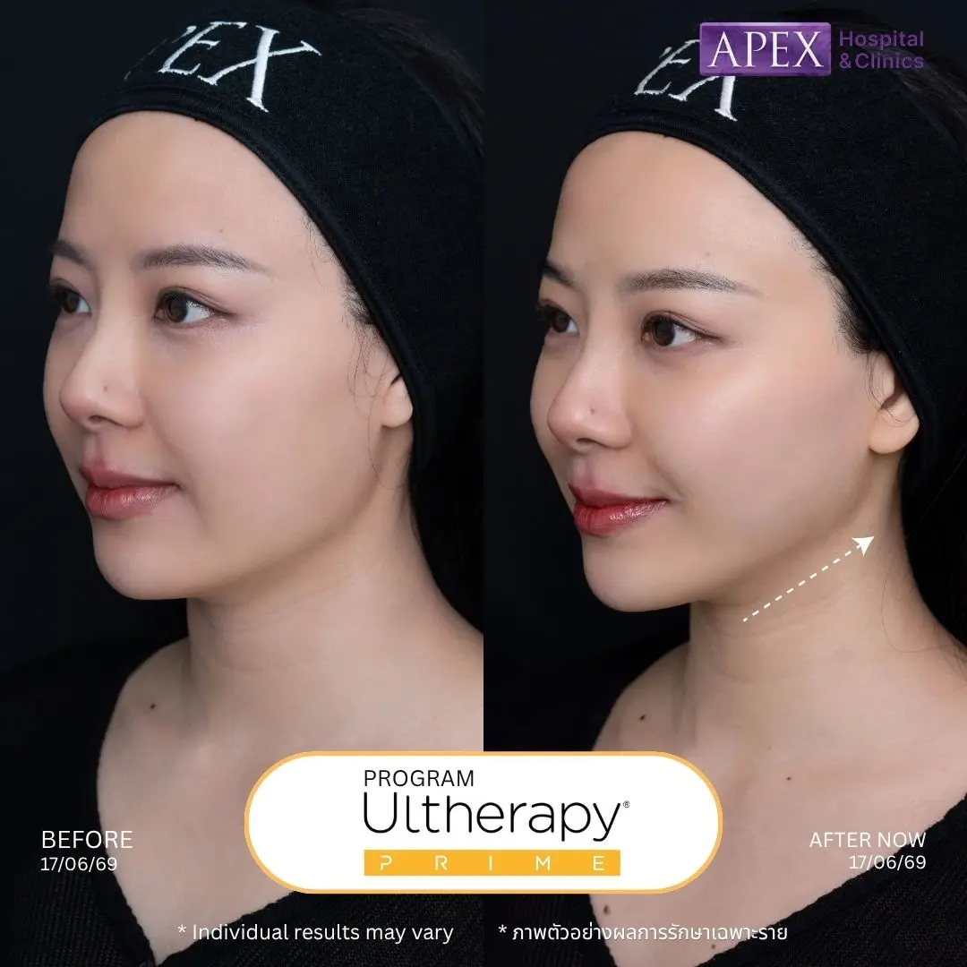 Ulthera ยกกระชับหน้า