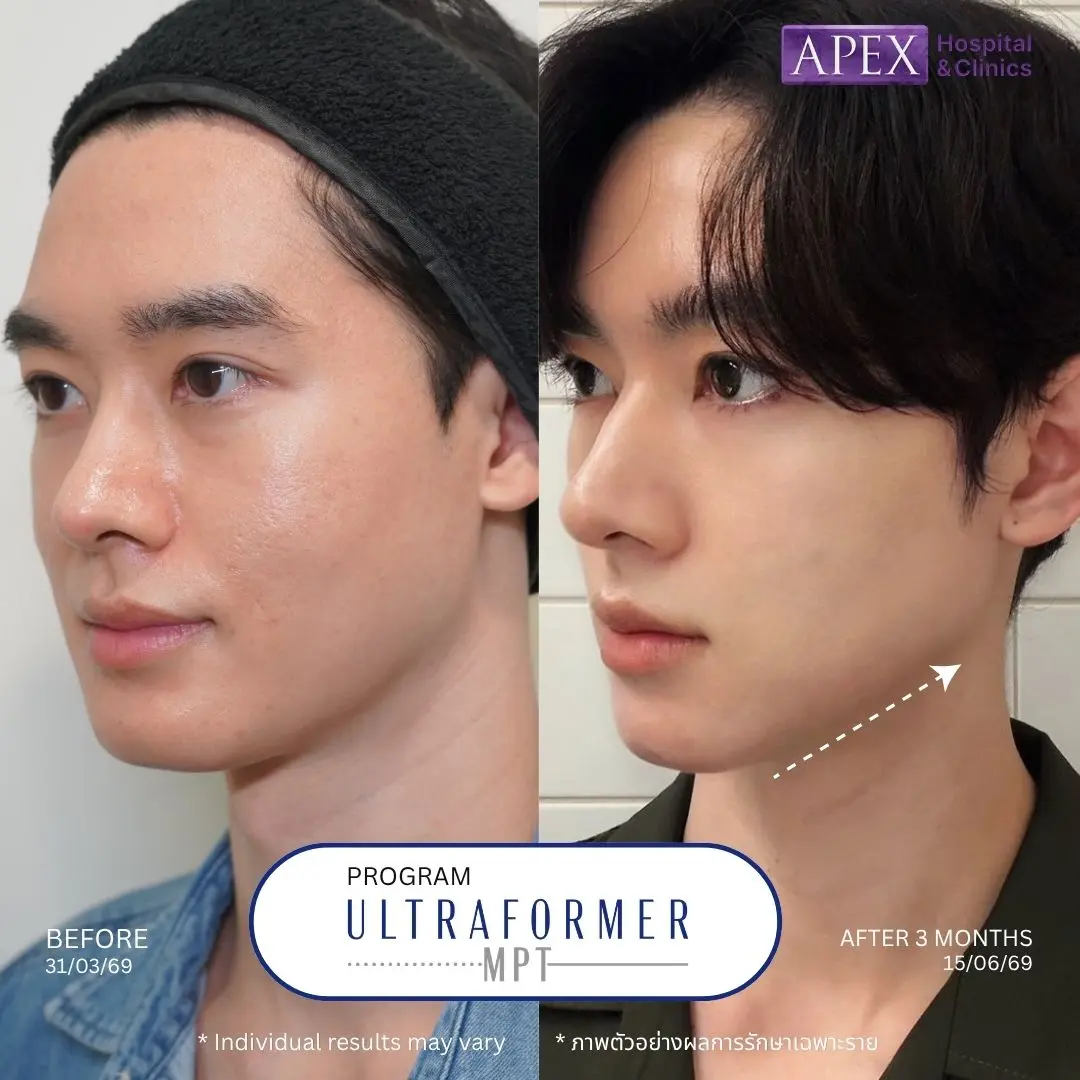 Ultraformer ยกกระชับหน้า