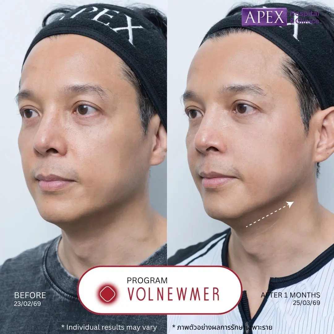 Volnewmer ยกกระชับหน้า
