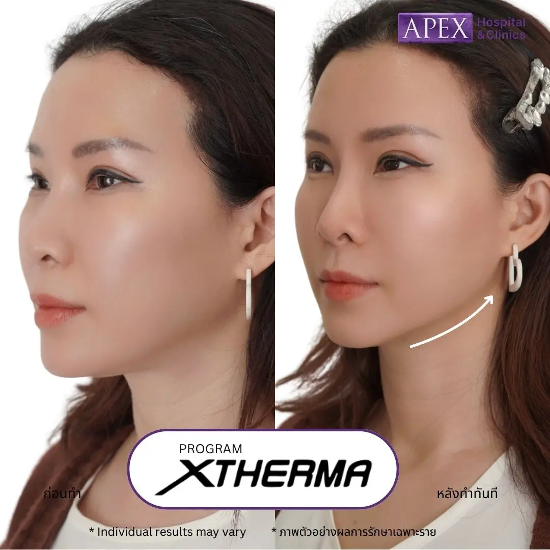 Xtherma ยกกระชับหน้า