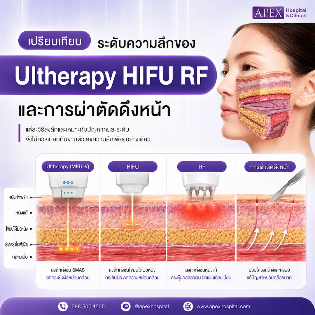 เปรียบเทียบระดับความลึกของ Ultherapy HIFU RF และการผ่าตัดดึงหน้า