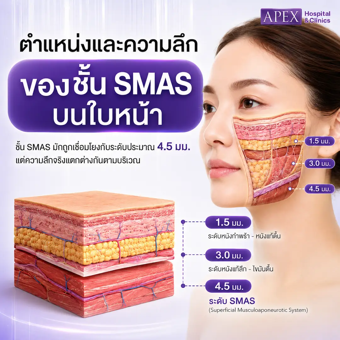 ตำแหน่งและความลึกของชั้น SMAS บนใบหน้า