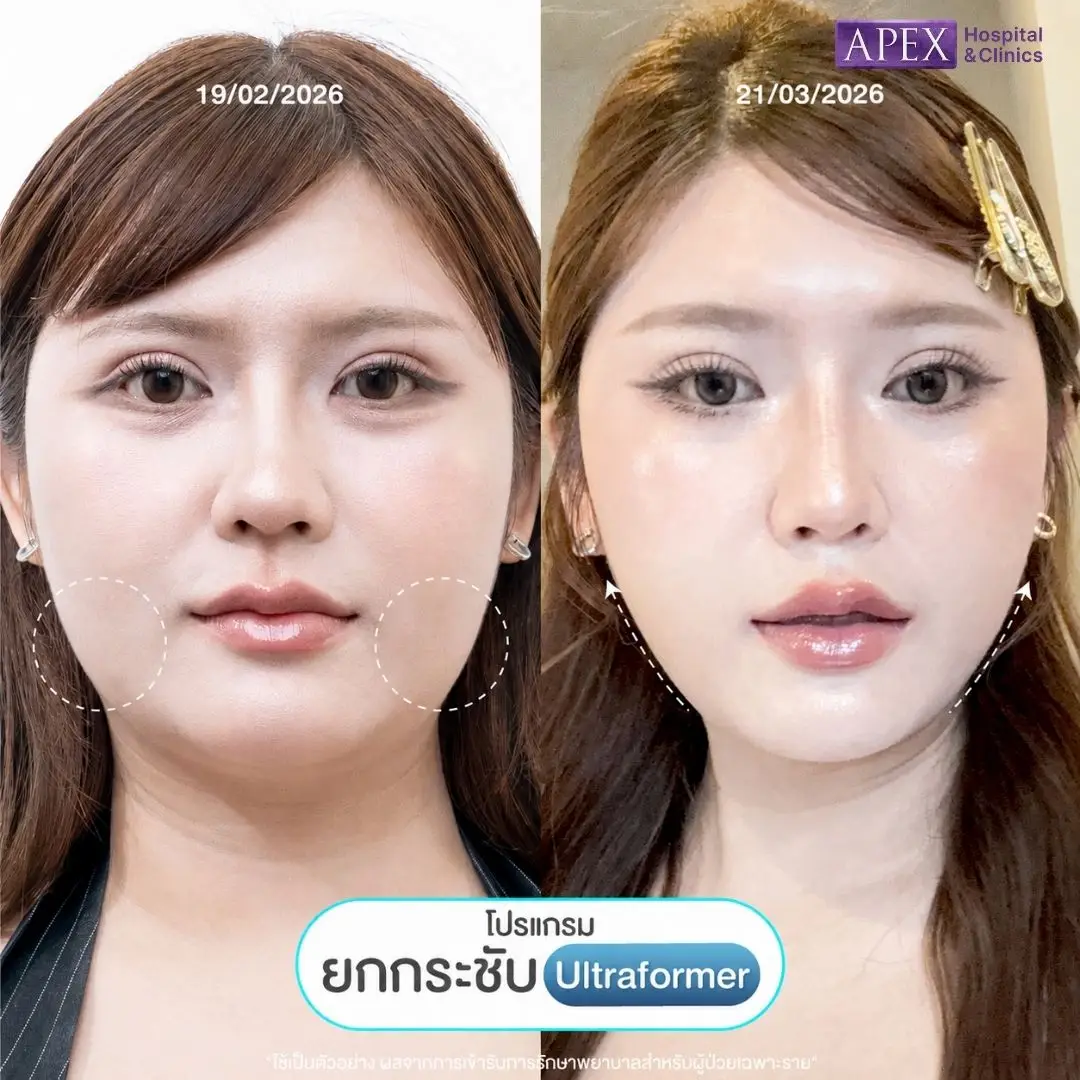 ผลลัพธ์หลังทำ Ultraformer