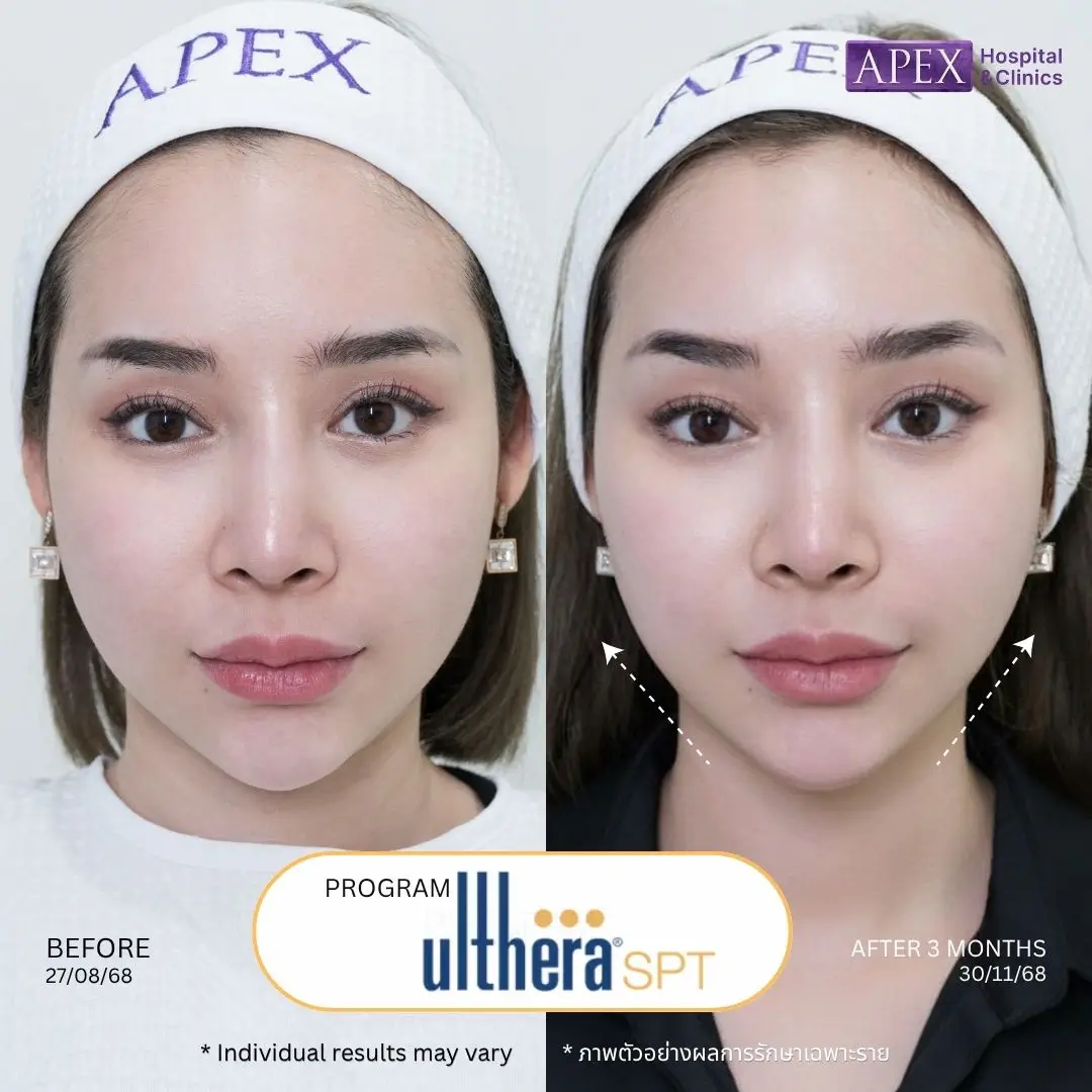 ผลลัพธ์หลังทำ Ulthera SPT