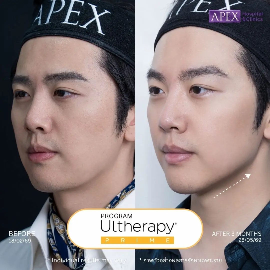 ผลลัพธ์หลังทำ Ulthera Prime