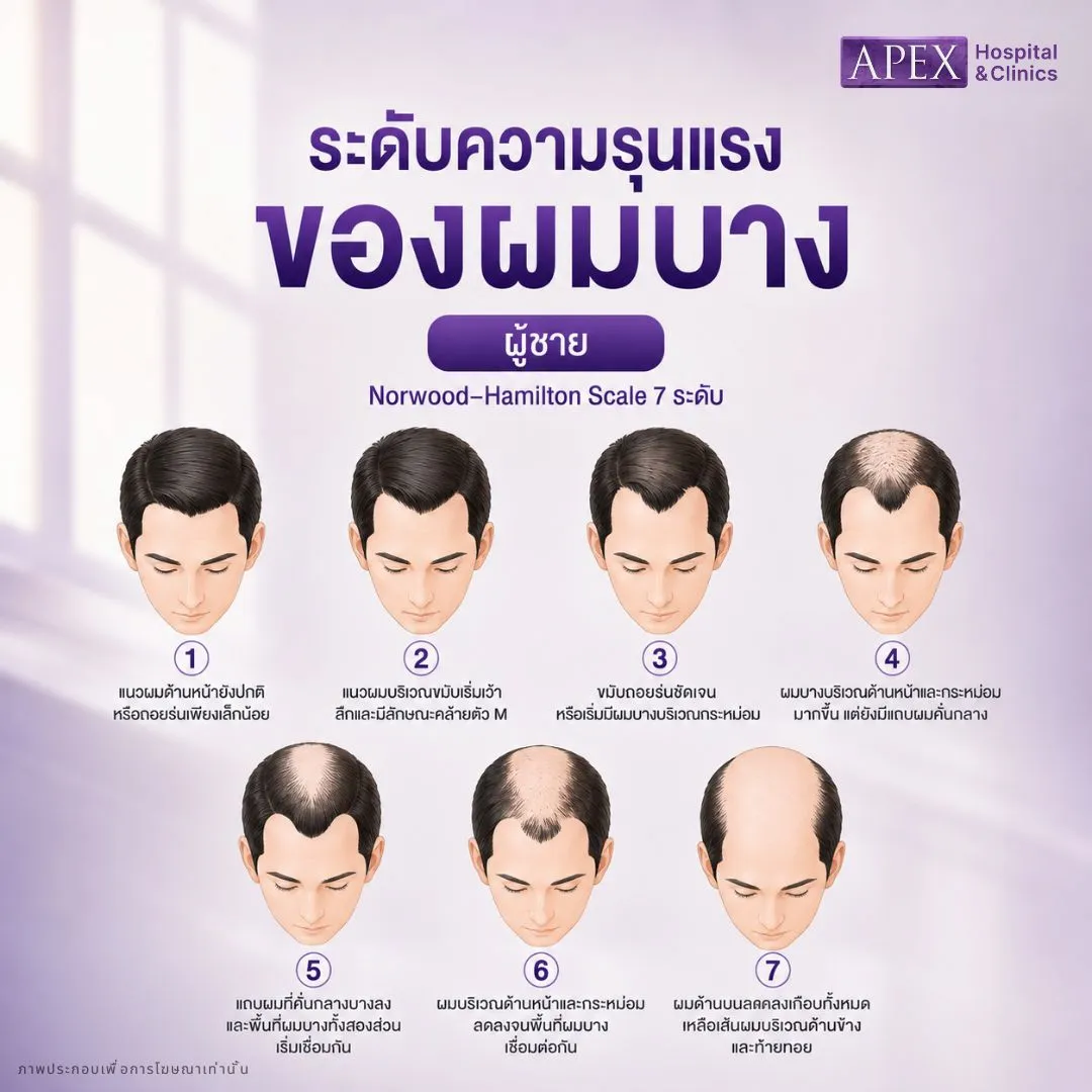 ผมร่วง ผู้ชาย