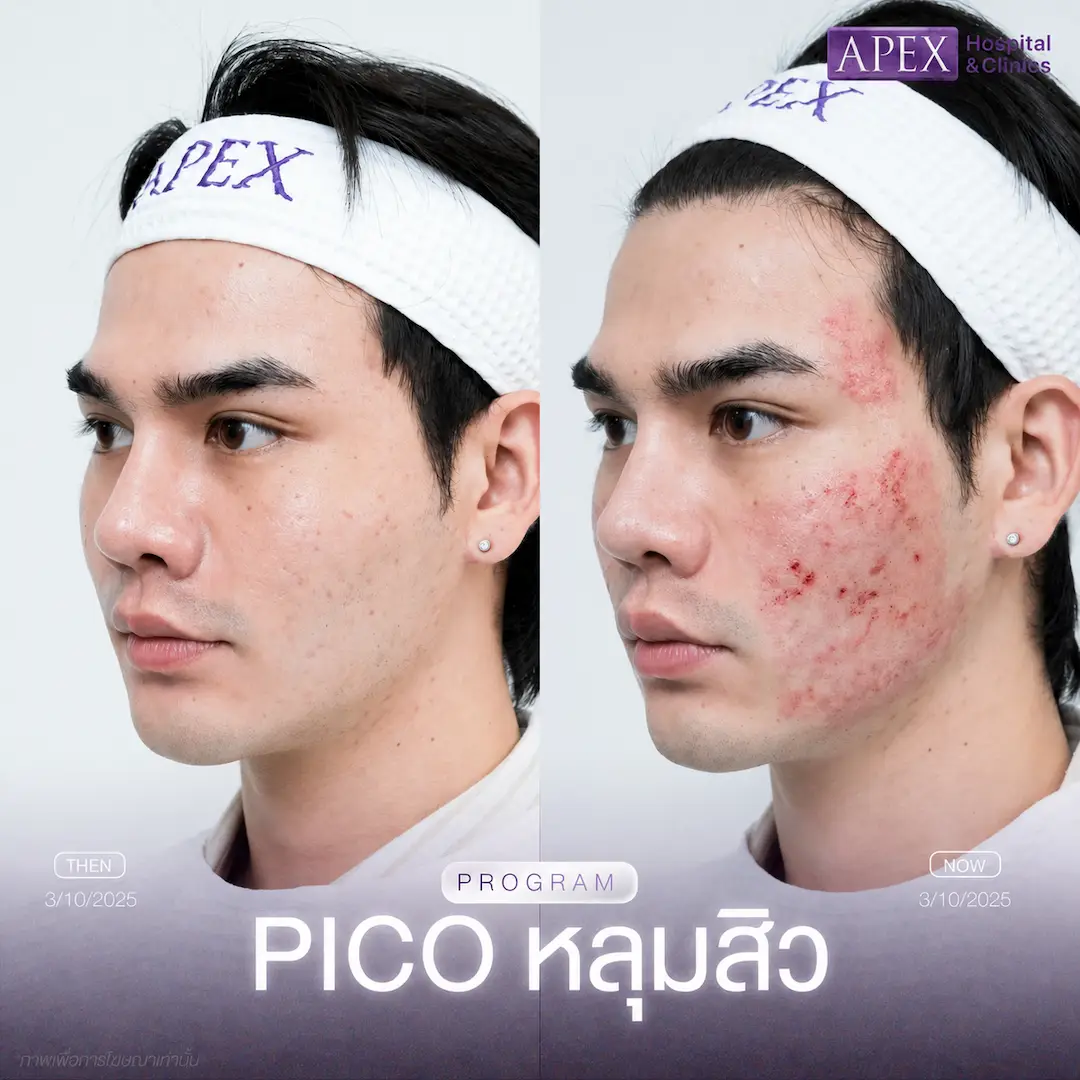 รีวิว Pico Laser หลังทำทันที