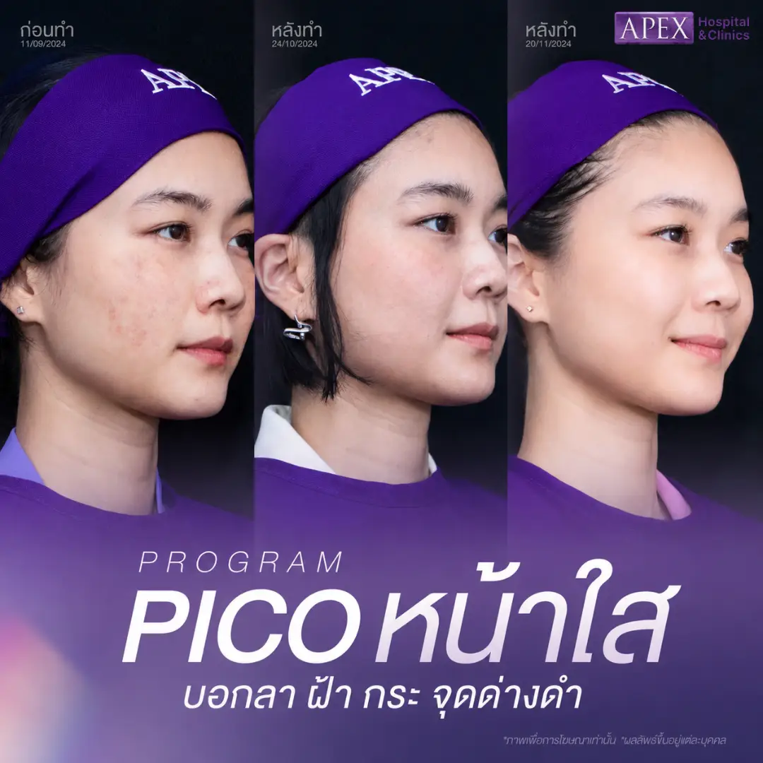 รีวิว Pico Laser เคสฝ้า กระ จุดด่างดำ และรอยสิว
