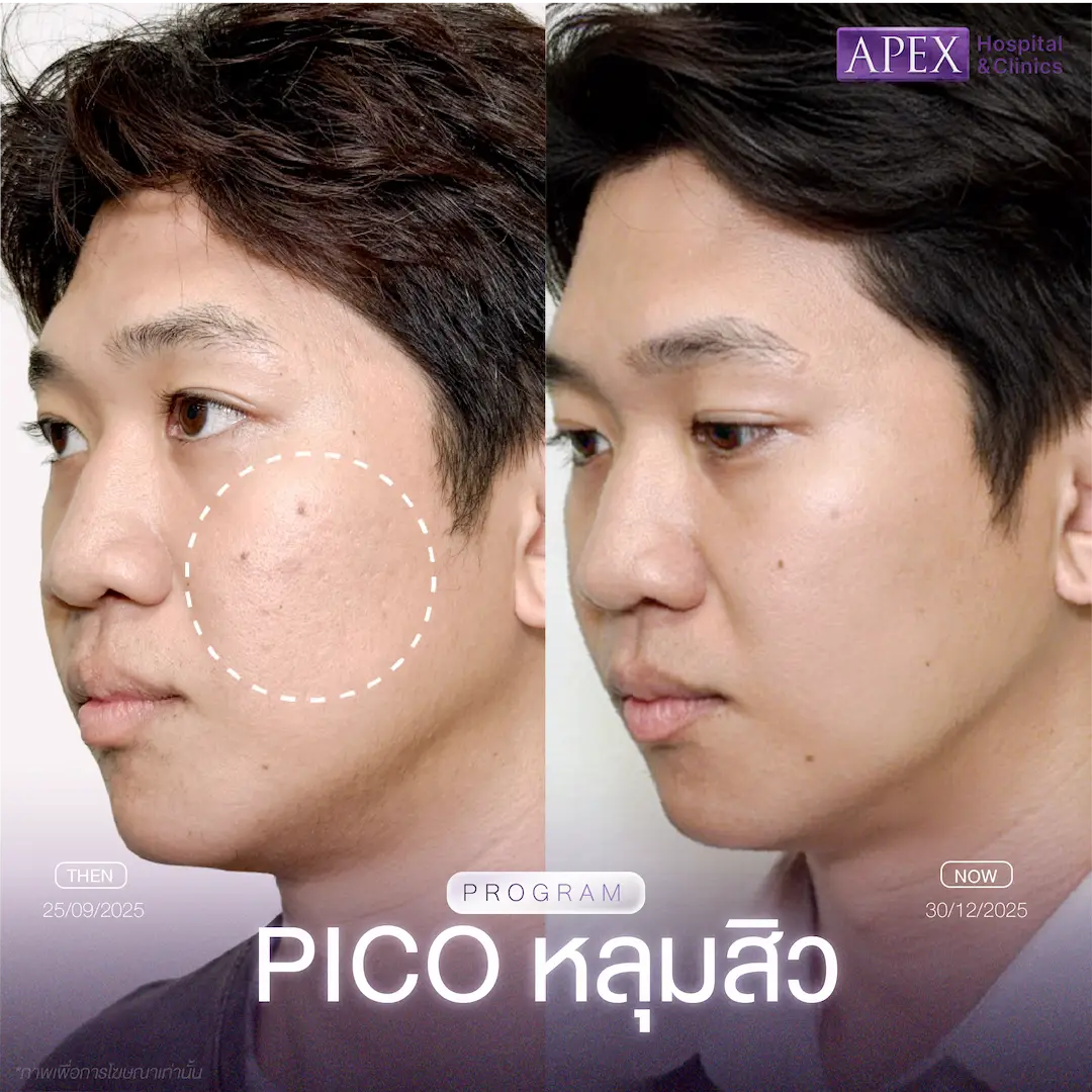 รีวิว Pico Laser เคสหลุมสิวตื้นและรอยดำกระจาย