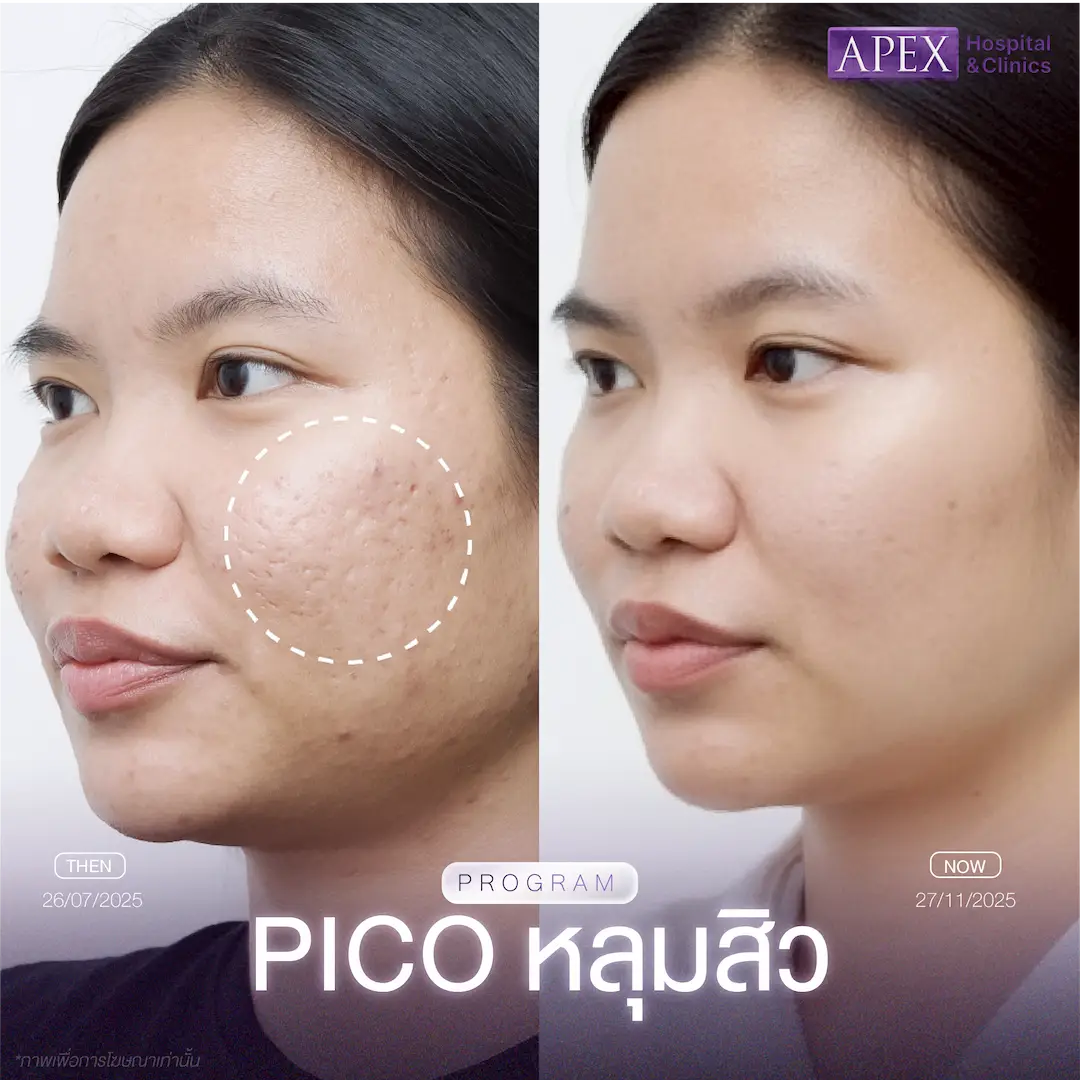 รีวิว Pico Laser เคสหลุมสิวหลายตำแหน่งร่วมกับรอยดำ