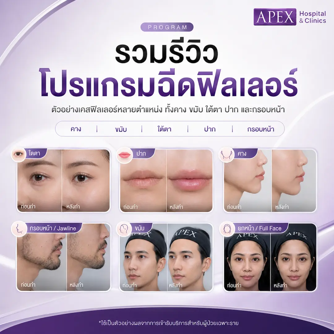 รีวิวฉีดฟิลเลอร์ Before-After
