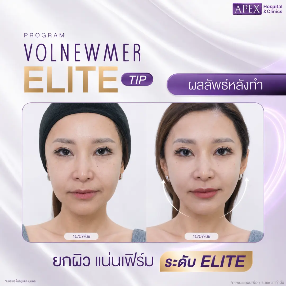 รีวิวผลลัพธ์หลังทำ Volnewmer Elite